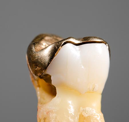 Eine grosse Goldfüllung sitzt auf einem Zahn