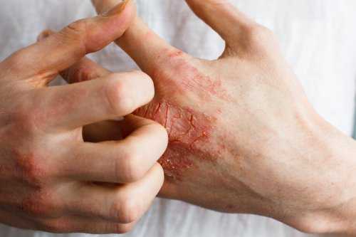 Zwei männliche Hände juckend durch eine chronisch-entzündliche Hauterkrankung und Neurodermitis 